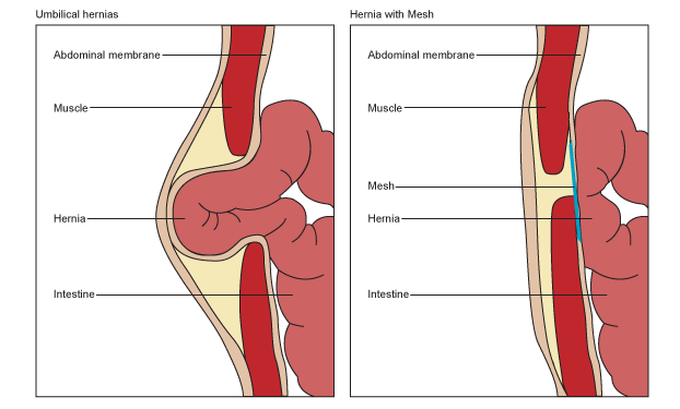 Umbilical Hernia Repair-Get Best Treatment by Freedom From Obesity 